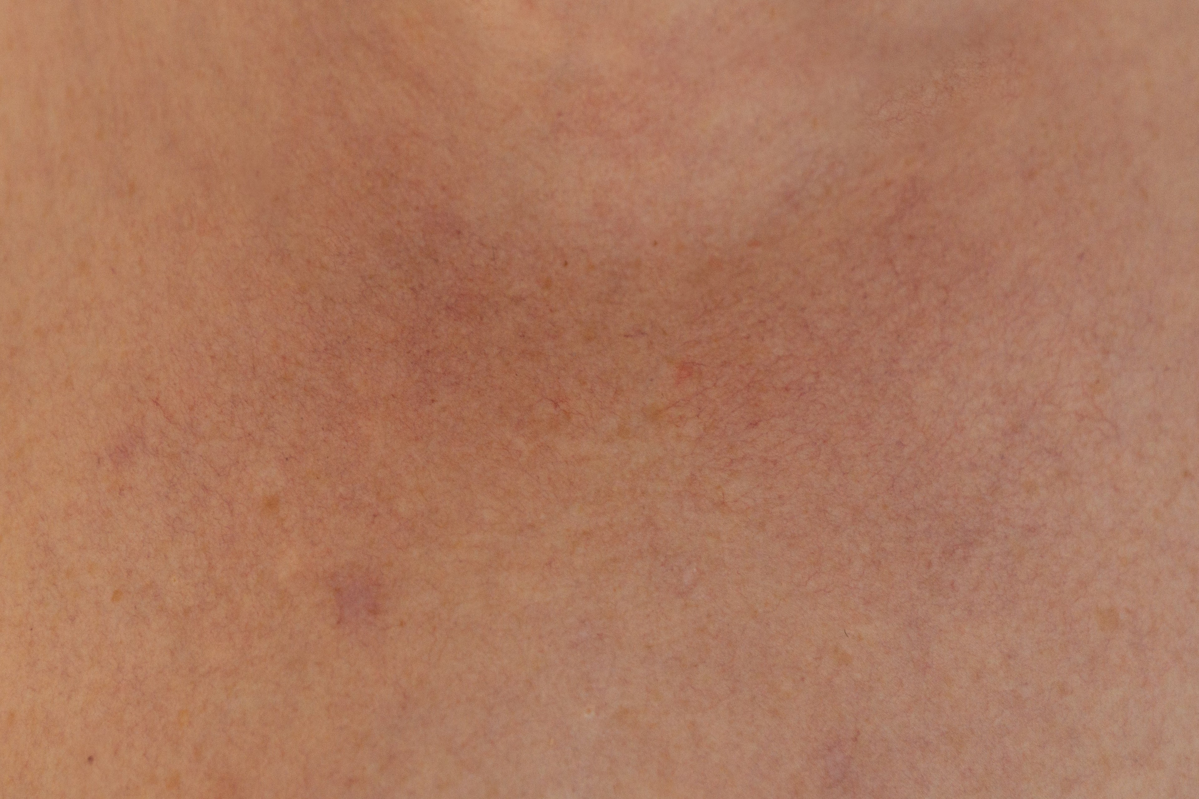 What is the Best Goat Milk Soap for Rosacea?
